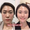 Peel tái tạo da chuyên sâu, cho da mụn nám tàn nhang và LCL to CNP Rx Skin Rejuvenating Intensive Peel 5ml 