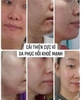 Peel tái tạo da chuyên sâu, cho da mụn nám tàn nhang và LCL to CNP Rx Skin Rejuvenating Intensive Peel 2ml 