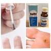 DUNG DICH TRỊ MỤN CÓC,MẮC CÁ CHÂN DUOFILM 15 ML (Pháp)