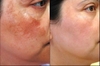 4 lí do khiến bạn trị nám thất bại dù dùng kem trị nám đắt tiền