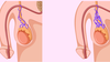 Giãn Tĩnh Mạch Thừng Tinh Có Con Được Không? Có Cần Can Thiệp Không?