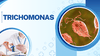 Trichomoniasis Là Bệnh Gì? Lây Qua Đâu Và Dấu Hiệu Cần Nhận Biết