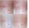 Miếng dán mụn Ciracle Red Spot Acne Pimple Path 24 Miếng