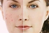 Sữa Rửa Mặt SVR Sebiaclear Gel Moussant & Topialyse Gel Lanvant Pháp