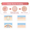 Miếng dán mụn Some By Mi Acnes Clear Patch Hàn Quốc