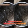 Dầu Gội Trị Gầu Nataki 780ml Anti-Dandruff Shampoo Tại Hà Nội