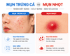 Phân Biệt Mụn Trứng Cá Và Mụn Nhọt: Cách Nhận Biết Và Xử Lý Chuẩn Y Khoa