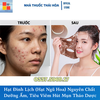 Hạt Đình Lịch (Hạt Ngũ Hoa) Nguyên Chất - Giải Pháp Tiêu Viêm, Hút Mụn Thảo Dược Tại Nhà