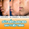 KEM ĐẶC TRỊ CÁC LOẠI NẤM DA VÀ LANG BEN FANGO-BD CREAM