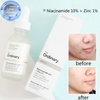 Tinh Chất The Ordinary Niacinamide 10% + Zinc 1%