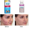 Chấm Mụn Bye Bye Blemish For Acne Drying Lotion USA 29.5ml