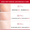 Siêu Tinh Chất Angle's Liquid Tranexamic Acid Mela Ampoule 30ml