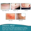 MIẾNG DÁN GIẢM MỜ VẾT SẸO DO PHẪU THUẬT VẾT MỔ VÀ SẸO LỒI - MEDICAL GRADE SILICONE SCAR SHEETS