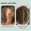 SERUM HỖ TRỢ GIẢM RỤNG TÓC - HERS TOPICAL MINOXIDIL SOLUTION, 2% - HAIR GROWTH TREATMENT FOR WOMEN - CLINICALLY PROVEN TO REDUCE HAIR LOSS IN 3-6 MONTHS - UNSCENTED, 2 PACK