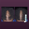 BỌT KÍCH THÍCH MỌC TÓC DÀNH CHO NỮ MINOXIDIL 5% - WOMEN'S ROGAINE 5% MINOXIDIL FOAM FOR HAIR THINNING AND LOSS, 2.11 OZ X2 CHAI