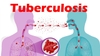 Bệnh Lao: Nguyên Nhân, Triệu Chứng, Cách Phòng Ngừa Và Điều Trị Hiệu Quả