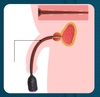 Sounding rung kích thích niệu đạo Dicovery Stick Jiuai