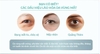 ya-man-medi-lift-eye-epe-10bb-san-pham-tri-lieu-chuyen-biet-vung-mat