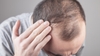 Nguyên nhân rụng tóc ở nam / nữ và cách trị rụng tóc