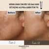 KEM TRỊ NÁM ALPHA ARBUTIN 7% CREAM