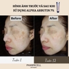 KEM TRỊ NÁM ALPHA ARBUTIN 7% CREAM