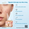 Nguyên nhân chính gây nên mụn đầu trắng