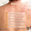 Những điều cần lưu ý khi bạn bị mụn cơ thể