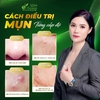 Cách điều trị mụn theo từng cấp độ 🔻