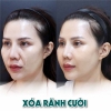 TIÊM FILLER XÓA RÃNH CƯỜI LÀ GÌ ? CẦN LƯU Ý NHỮNG GÌ ?
