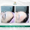 🌟 Cấy chỉ Collagen nội khoa – Giải pháp cho vầng trán đầy đặn, cân đối và phúc hậu 🌟