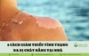 8 Cách giảm thiểu tình trạng da bị cháy nắng hiệu quả ngay tại nhà