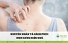 Nguyên nhân và cách phục mụn lưng hiệu quả
